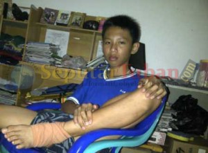 Michael Eka Juanda, kondisi kakinya masih bengkak akibat terjatuh karena kedua kakinya terikat saat dihukum wali kelasnya bersama 19 teman lainya selama sepekan