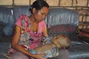 Tuban - Balita penyakit komplikasi